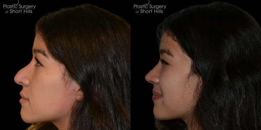 Revision Rhinoplasty Patient