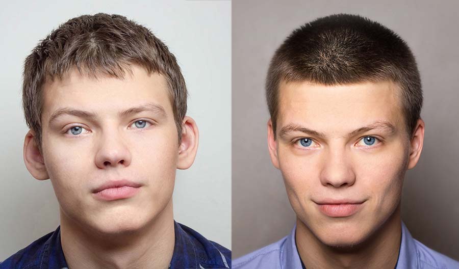 Young man before and after  Otoplasty procedure. Dr. Ovchinsky Plastic Surgery of Short Hill.
