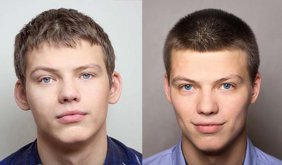 Young man before and after Otoplasty procedure. Dr. Ovchinsky Plastic Surgery of Short Hill.