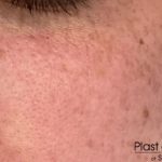 RF Microneedling Before & After Patient #17444