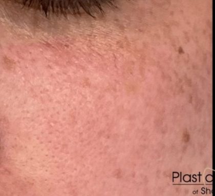 RF Microneedling Before & After Patient #17444