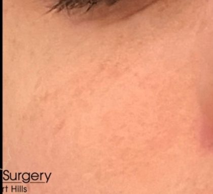 RF Microneedling Before & After Patient #17444