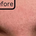 RF Microneedling Before & After Patient #17444