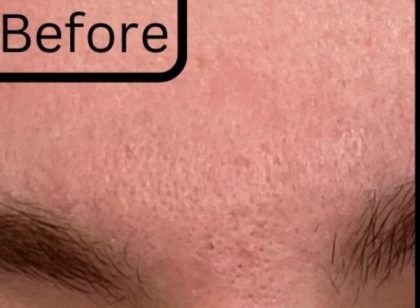 RF Microneedling Before & After Patient #17444