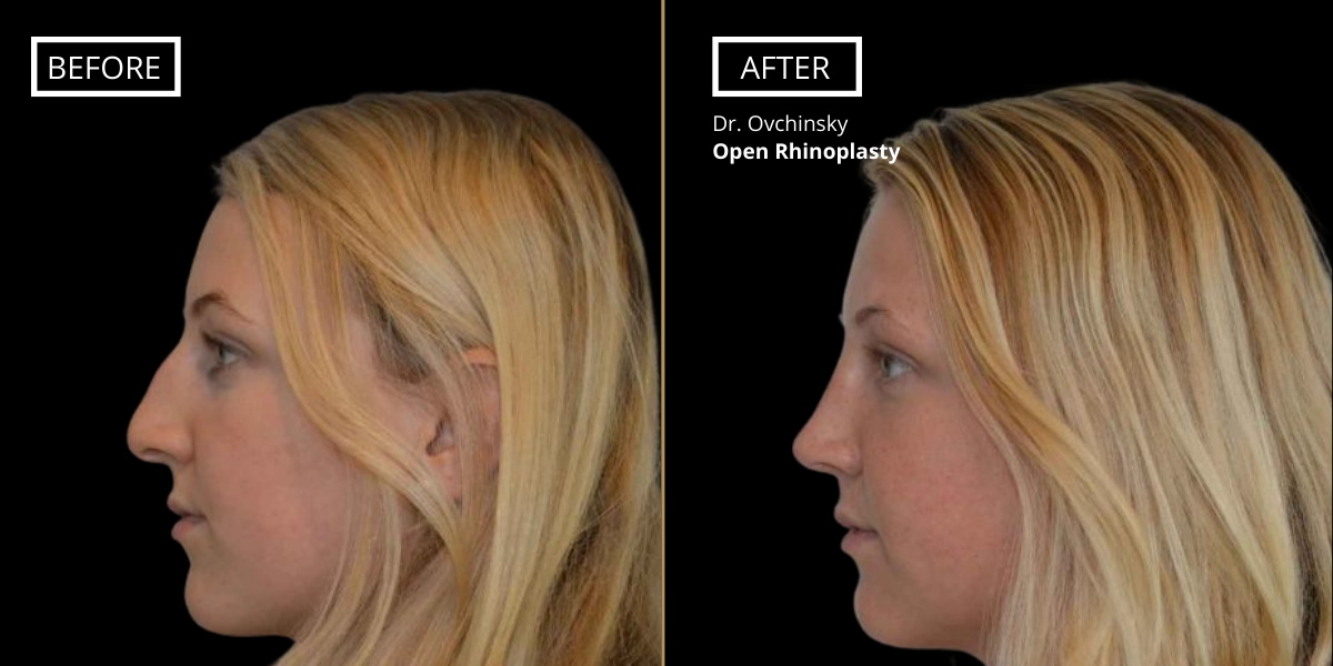 Best Open Vs. Closed Rhinoplasty Should I get an open or closed