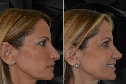 Facial Cosmetic Procedures