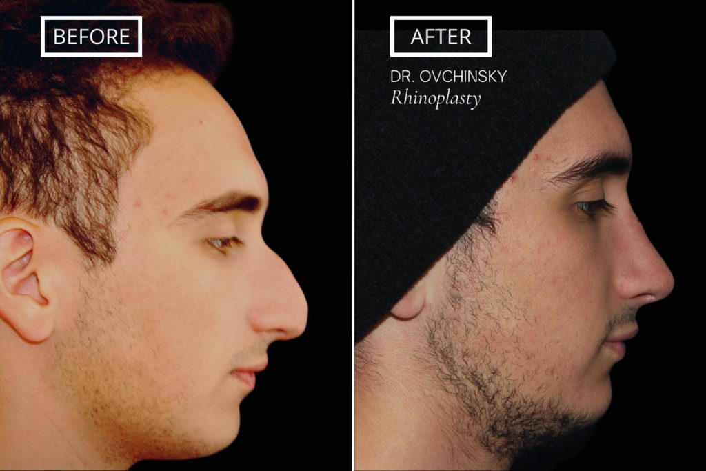 Male Rhinoplasty Short Hills