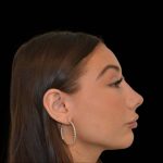 Rhinoplasty Before & After Patient #17455