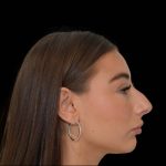 Rhinoplasty Before & After Patient #17455