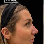 Liquid Rhinoplasty(Non-Surgical) Before & After Patient #17553