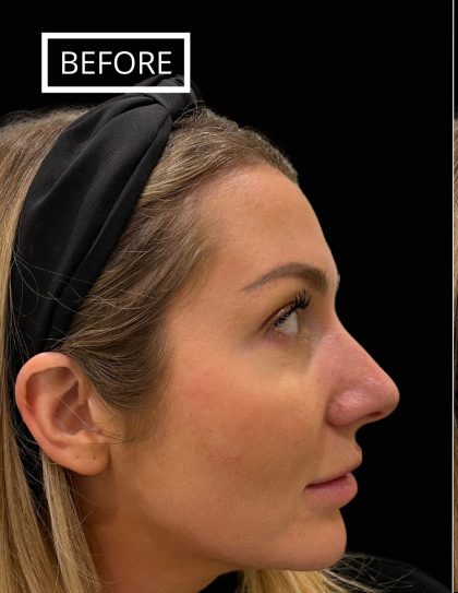 Liquid Rhinoplasty(Non-Surgical) Before & After Patient #17553