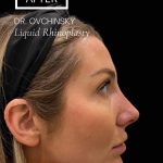 Liquid Rhinoplasty(Non-Surgical) Before & After Patient #17553