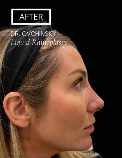 Liquid Rhinoplasty(Non-Surgical) Before & After Patient #17553