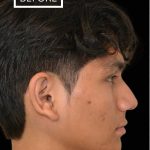 Rhinoplasty Before & After Patient #17563