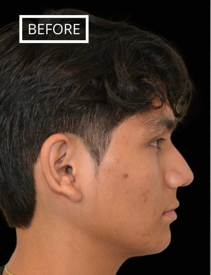 Rhinoplasty Before & After Patient #17563