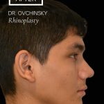 Rhinoplasty Before & After Patient #17563