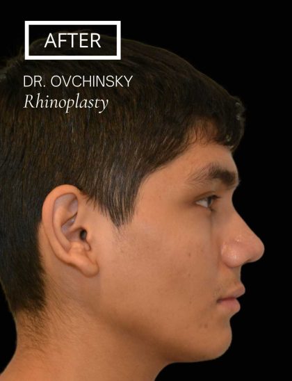 Rhinoplasty Before & After Patient #17563
