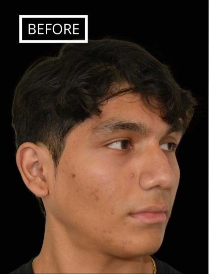 Rhinoplasty Before & After Patient #17563