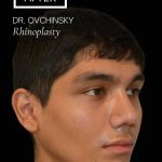 Rhinoplasty Before & After Patient #17563