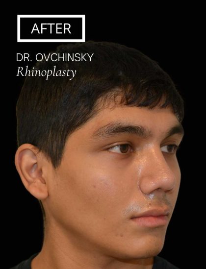 Rhinoplasty Before & After Patient #17563