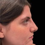 Liquid Rhinoplasty(Non-Surgical) Before & After Patient #17628