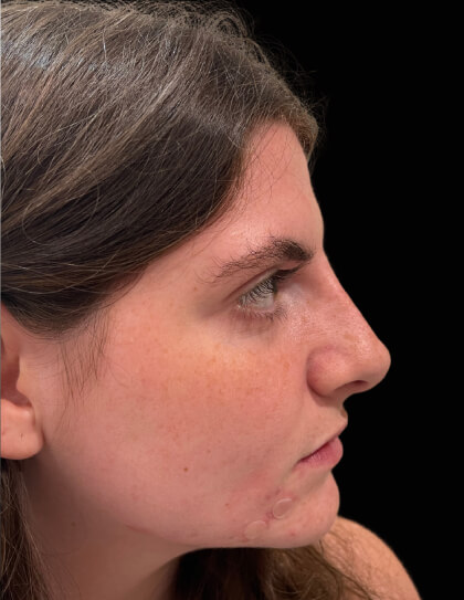 Liquid Rhinoplasty(Non-Surgical) Before & After Patient #17628