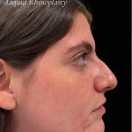 Liquid Rhinoplasty(Non-Surgical) Before & After Patient #17628