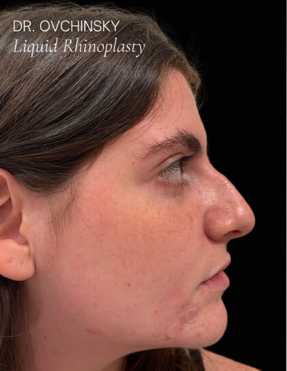 Liquid Rhinoplasty(Non-Surgical) Before & After Patient #17628