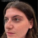 Liquid Rhinoplasty(Non-Surgical) Before & After Patient #17628