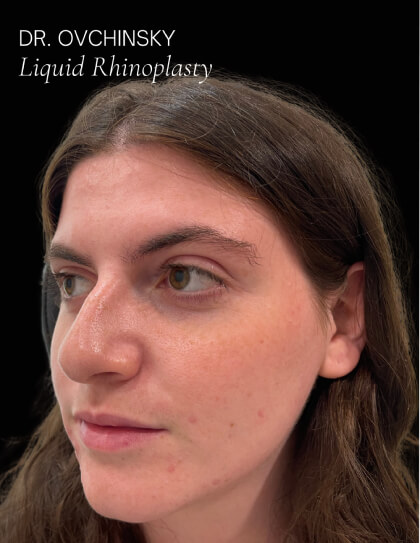 Liquid Rhinoplasty(Non-Surgical) Before & After Patient #17628