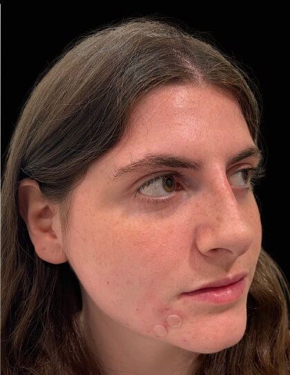 Liquid Rhinoplasty(Non-Surgical) Before & After Patient #17628