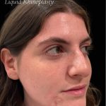 Liquid Rhinoplasty(Non-Surgical) Before & After Patient #17628