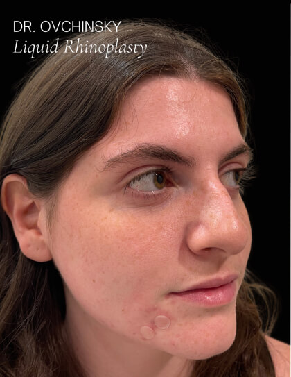 Liquid Rhinoplasty(Non-Surgical) Before & After Patient #17628