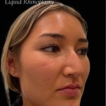 Liquid Rhinoplasty(Non-Surgical) Before & After Patient #17635