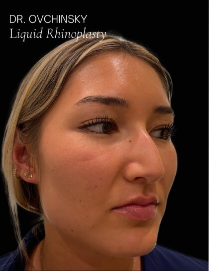 Liquid Rhinoplasty(Non-Surgical) Before & After Patient #17635