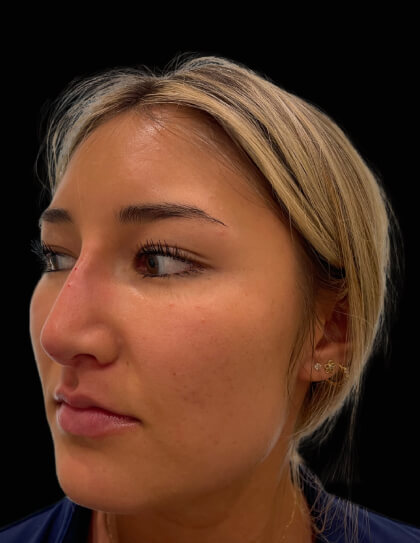 Liquid Rhinoplasty(Non-Surgical) Before & After Patient #17635