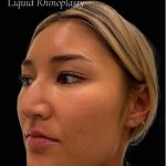 Liquid Rhinoplasty(Non-Surgical) Before & After Patient #17635