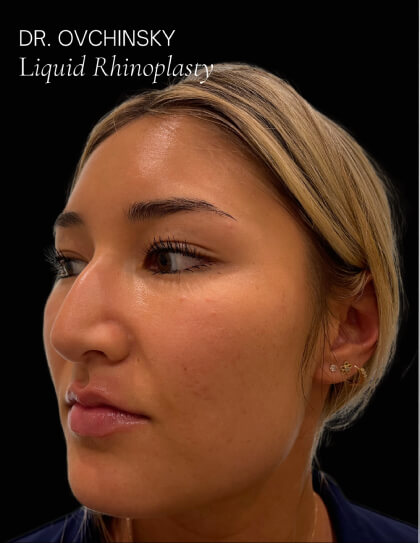 Liquid Rhinoplasty(Non-Surgical) Before & After Patient #17635