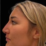 Liquid Rhinoplasty(Non-Surgical) Before & After Patient #17635