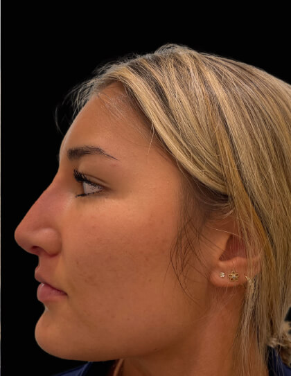 Liquid Rhinoplasty(Non-Surgical) Before & After Patient #17635