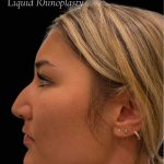 Liquid Rhinoplasty(Non-Surgical) Before & After Patient #17635