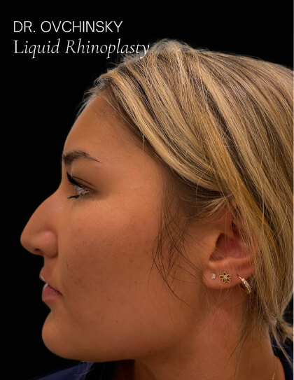 Liquid Rhinoplasty(Non-Surgical) Before & After Patient #17635