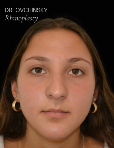 Rhinoplasty Before & After Patient #17594