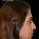 Rhinoplasty Before & After Patient #17596