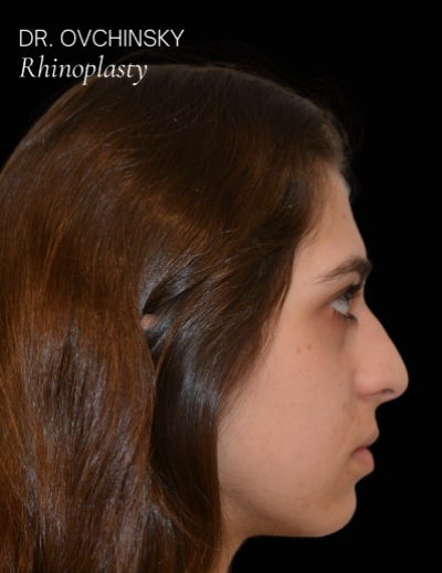 Rhinoplasty Before & After Patient #17596