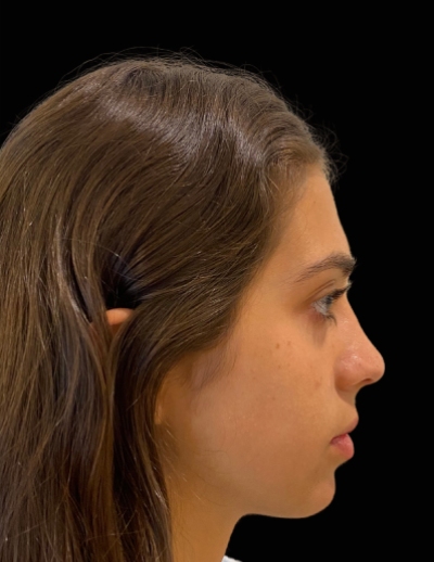 Rhinoplasty Before & After Patient #17596