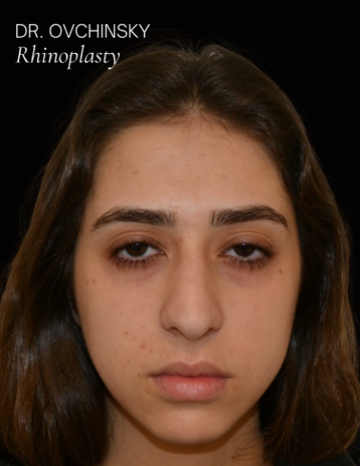 Rhinoplasty Before & After Patient #17596