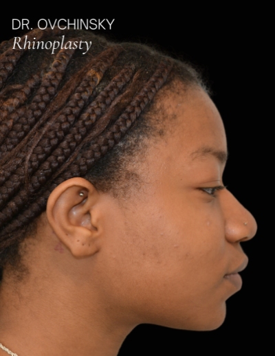 Rhinoplasty Before & After Patient #17595