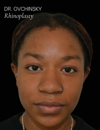 Rhinoplasty Before & After Patient #17595