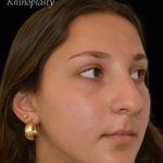 Rhinoplasty Before & After Patient #17594
